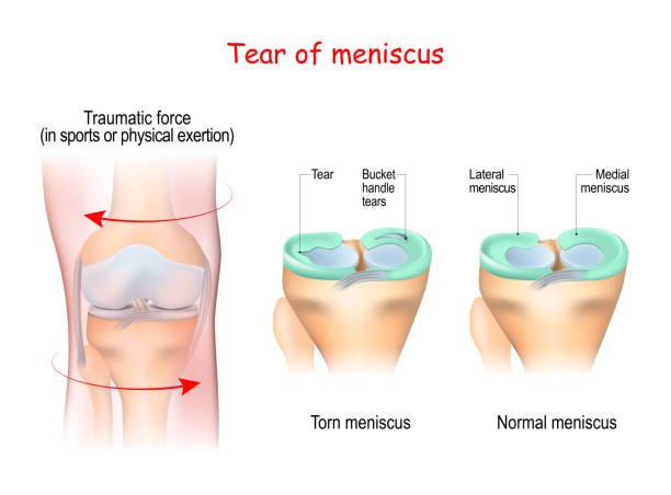 How to Avoid a Meniscus Tear During Exercise or Ordinary Activities - Cambivo